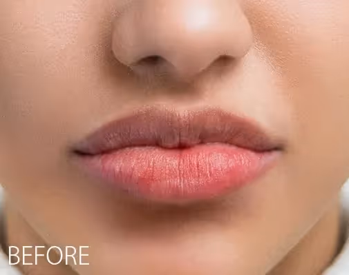 This specialized semi-permanent treatment is designed for clients with uneven lip color, pigmentation or unwanted darker areas. It focuses on color correcting and neutralizing the darker areas of the lips before applying a custom-blended pigment to achieve brighter, more even-toned lips. This is a two-appointment process, with a follow-up recommended 4-12 weeks after the initial session to assess healing and refine the results as needed.