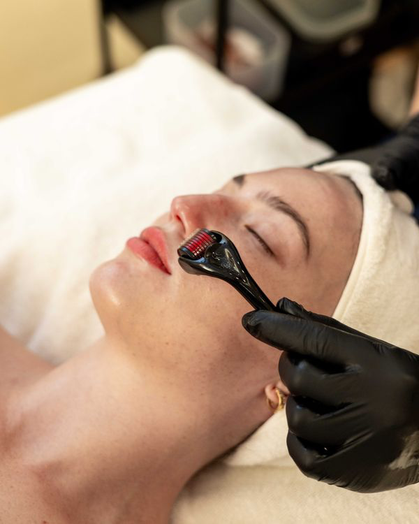Million Dollar Facial step 4: Skin Needling