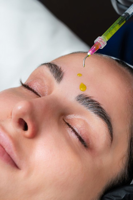 BioRePeel treatment for hyperpigmentation