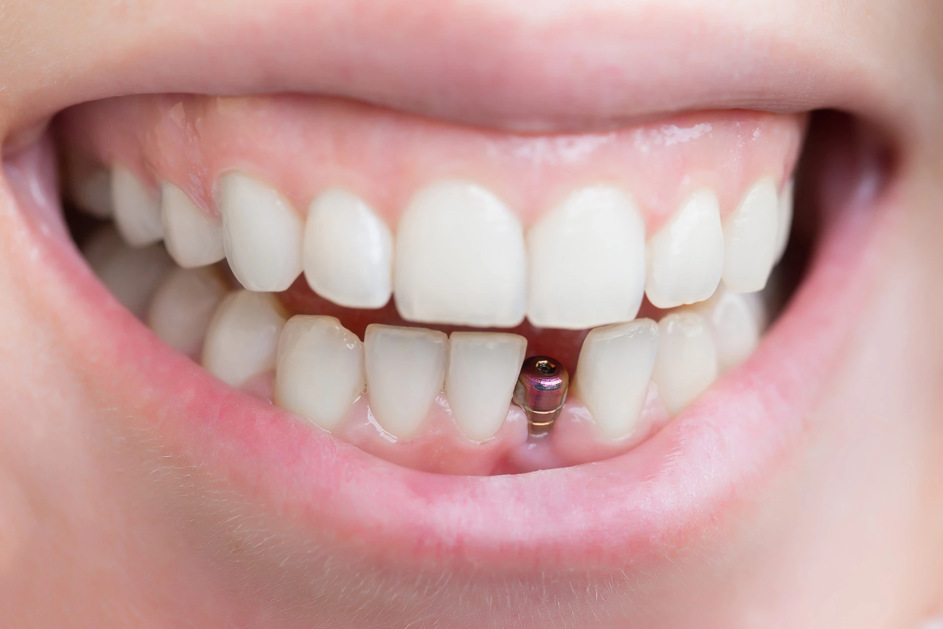 Implant Restoration in San Diego