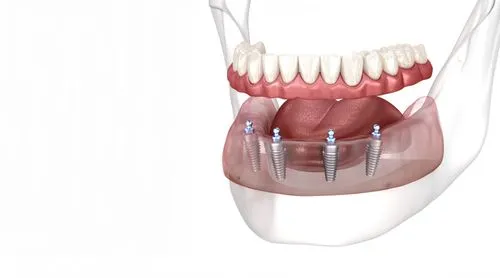 A model of a human mouth with dental implants