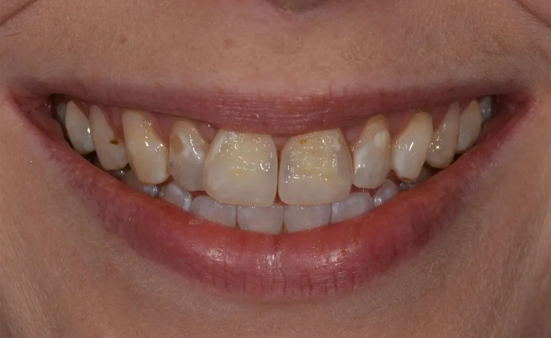 Close-up of slightly discolored teeth with a wide, bright smile