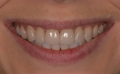 Close-up of bright, white smile with clean, straight teeth
