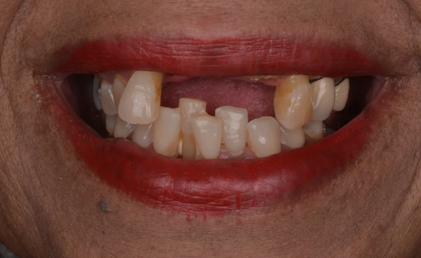 Close-up of misaligned and discolored teeth with red lips