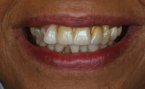 Close-up of a person's teeth and lips with a wide smile