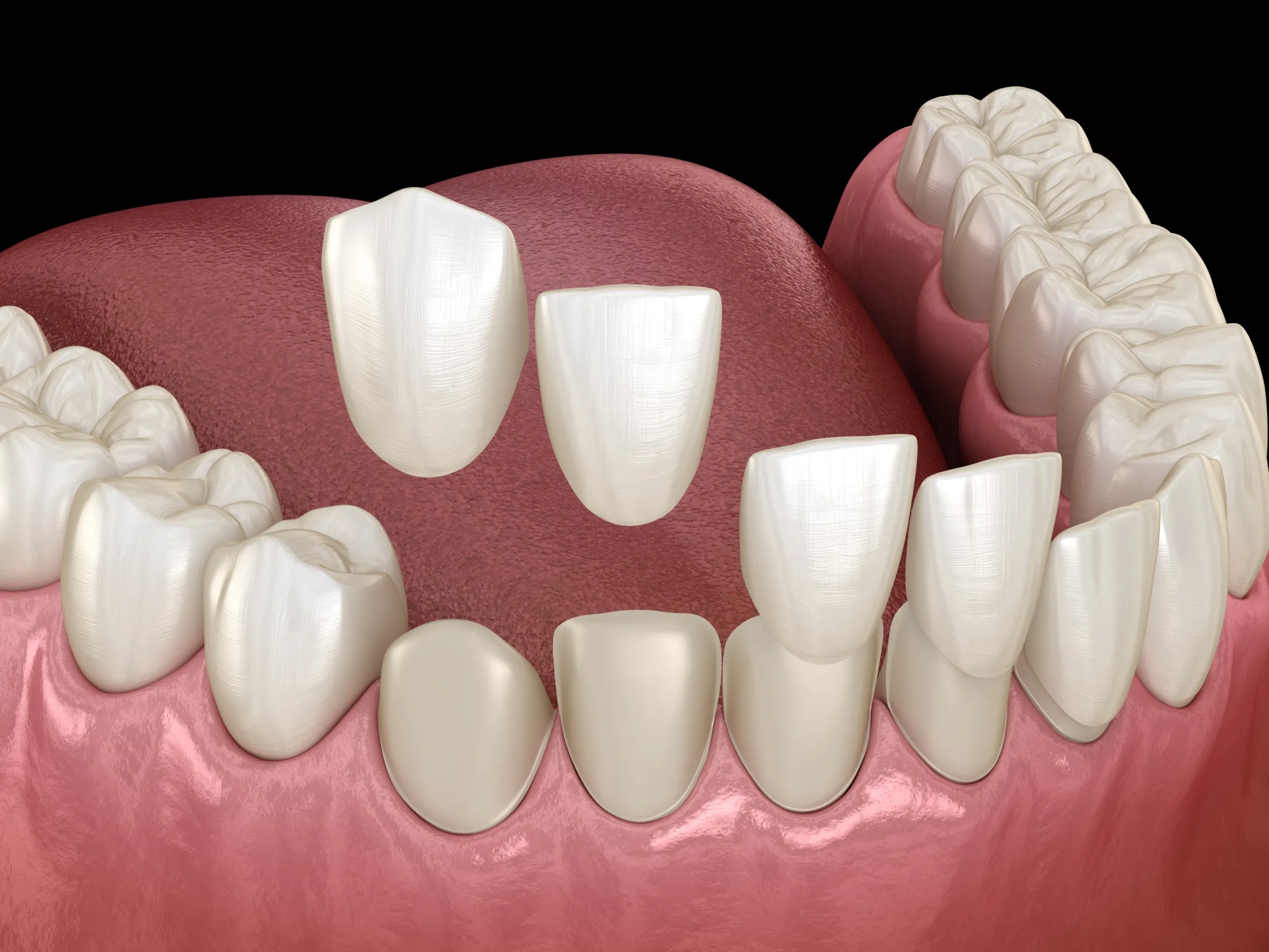 3D medical illustration of dental veneers on teeth and gums