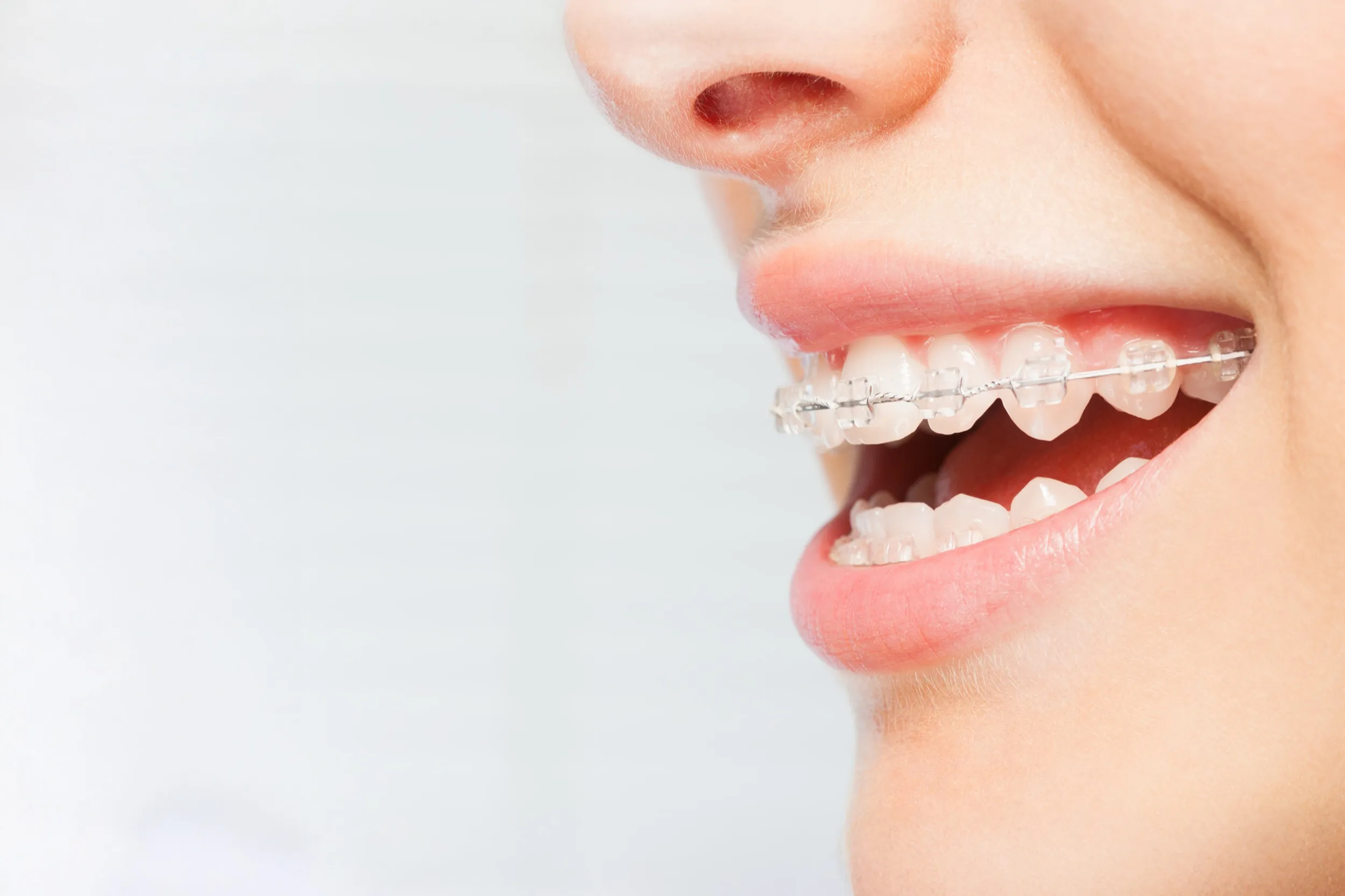 Mouth with ceramic braces, showing teeth alignment process