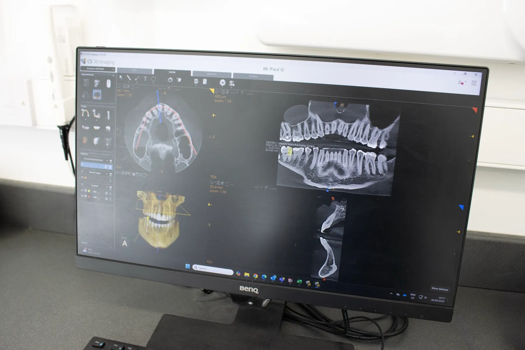 Dental X-ray imaging software displaying multiple views of teeth and jaw