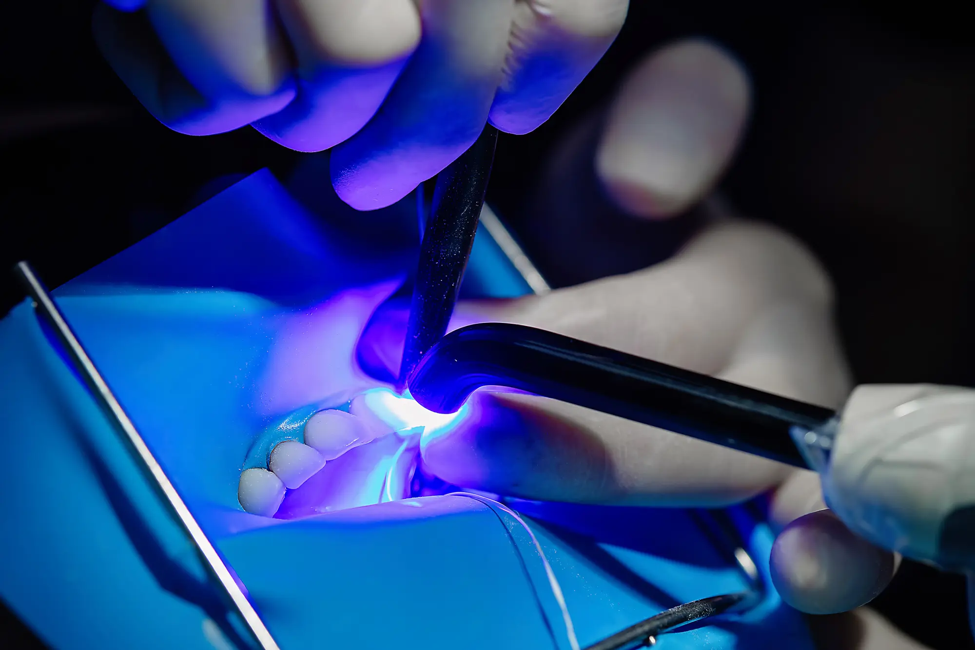 Dental Bonding in San Diego | Talmadge Family Dentistry