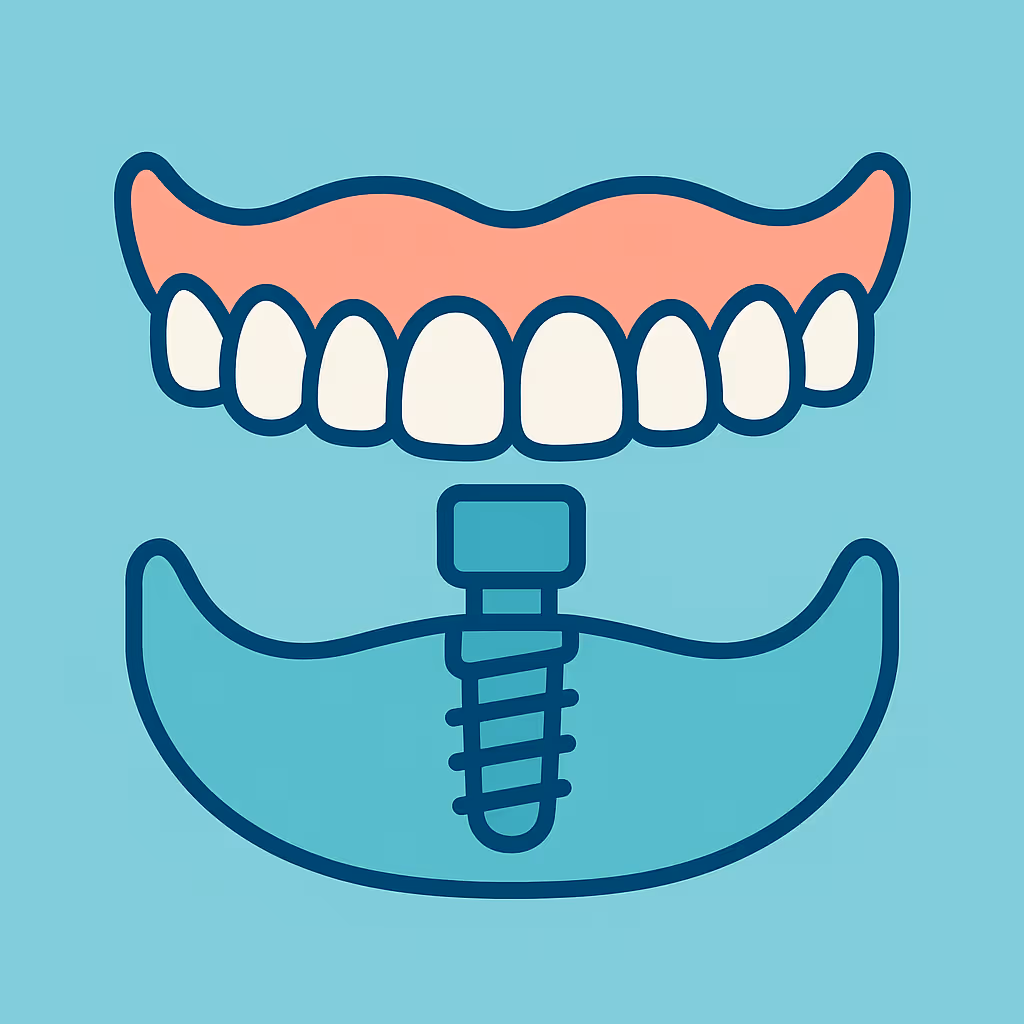 Understanding Dental Code D6112 – Implant /abutment supported removable denture for partially edentulous arch – maxillary
