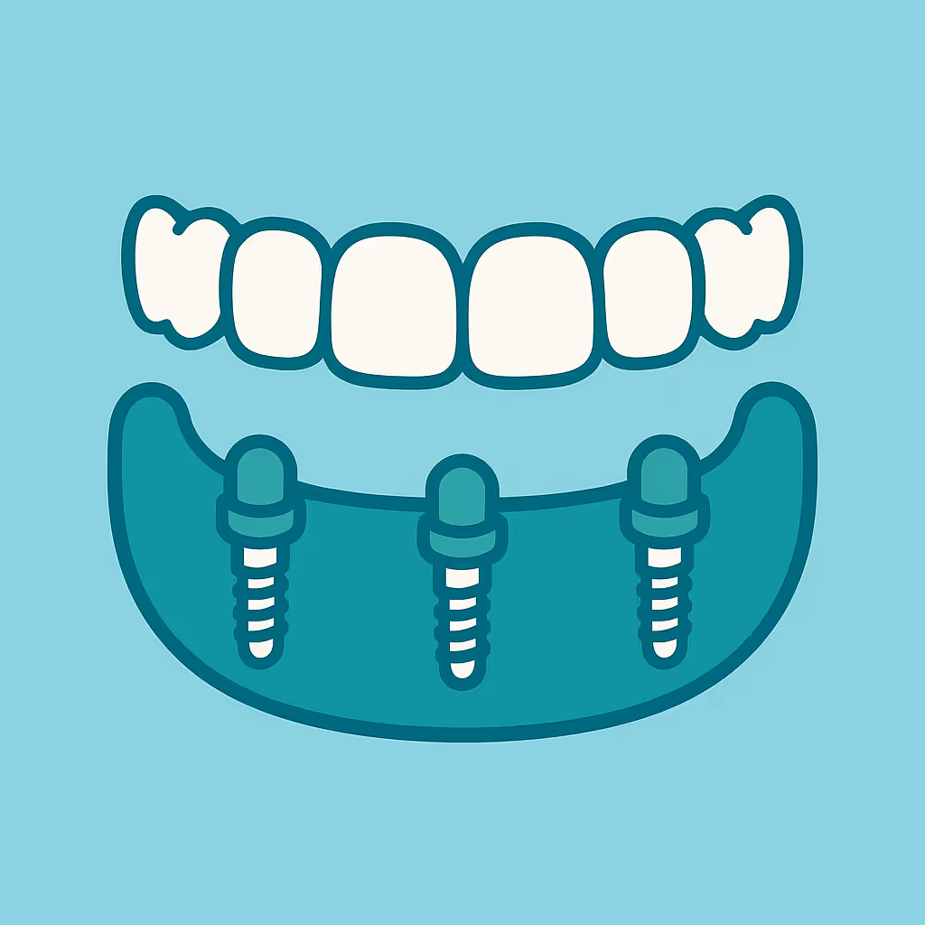 Understanding Dental Code D6115 – Implant /abutment supported fixed denture for edentulous arch – mandibular