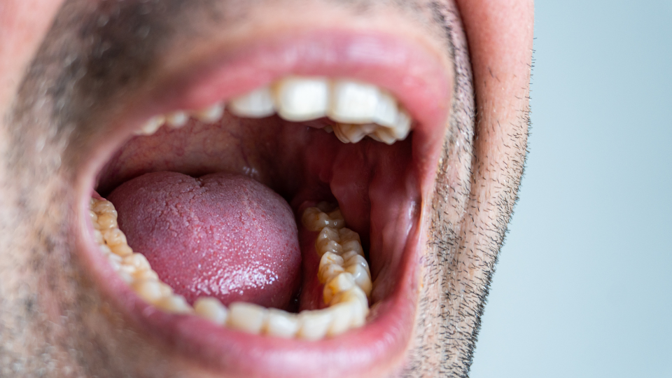 Why Does the Roof of My Mouth Hurt? Common Causes, Symptoms, and When to See a Dentist