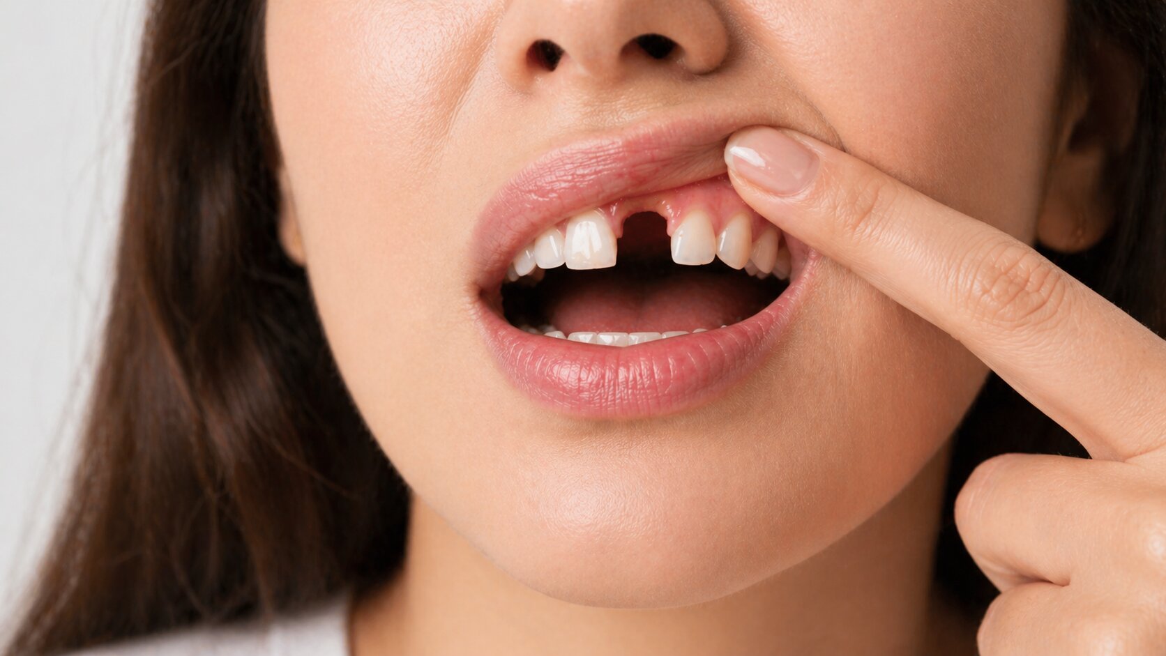 Close-up of a woman showing a knocked out upper tooth while pulling back her lip.