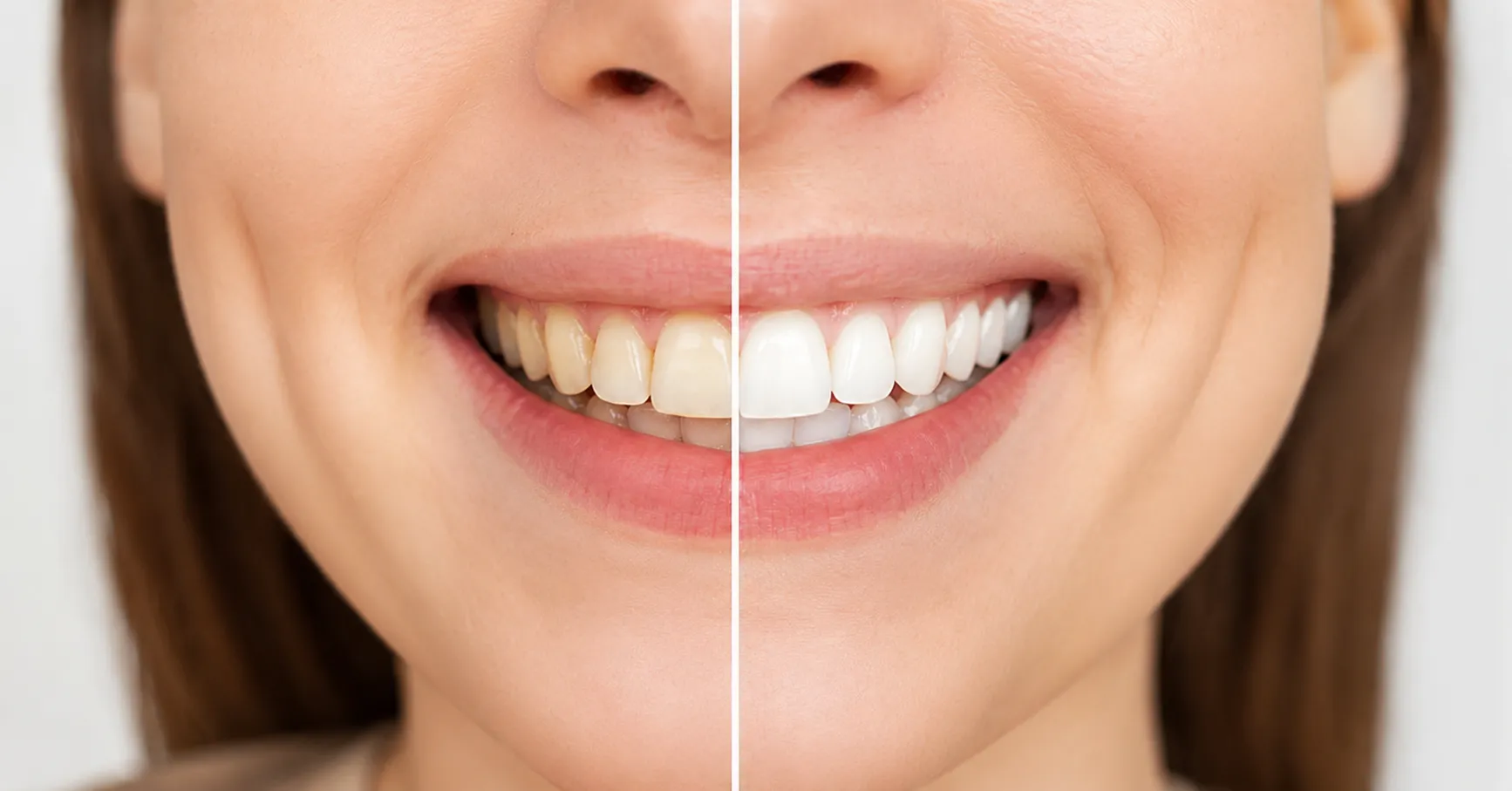 A before-and-after split image showing a close-up of a person's smile to demonstrate the results of teeth whitening. The left side displays naturally yellowed, stained teeth, while the right side showcases a bright, vibrant white smile.