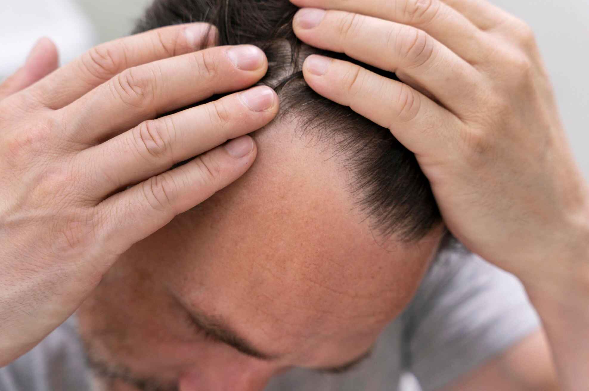 Close-up of a man examining his hairline, illustrating early signs and common causes of hair loss in men.