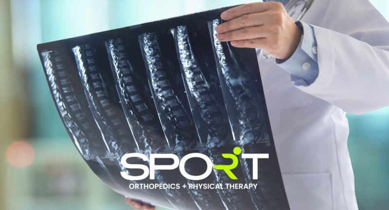 lumbosacral spondylosis