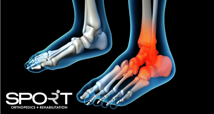 osteochondritis dessicans