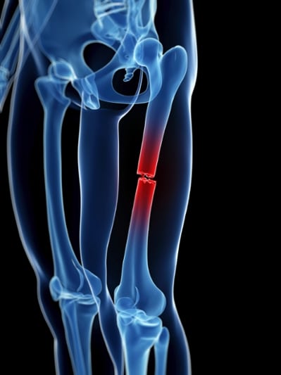 bone fracture treatment