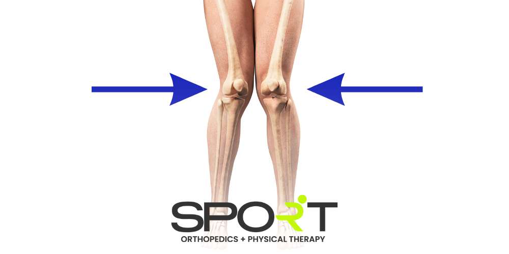 knock knees treatment dallas