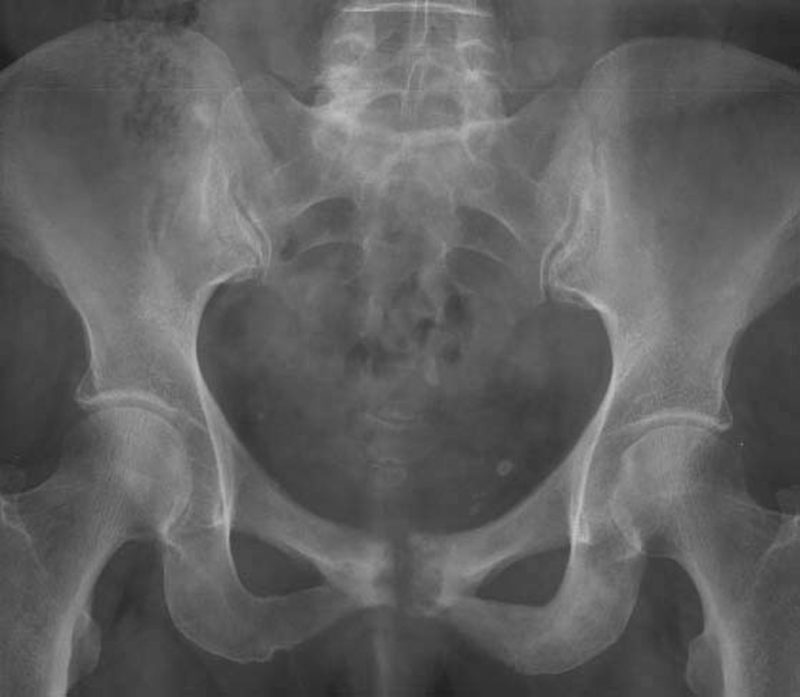 pubic bone pain