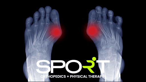 bunion treatment