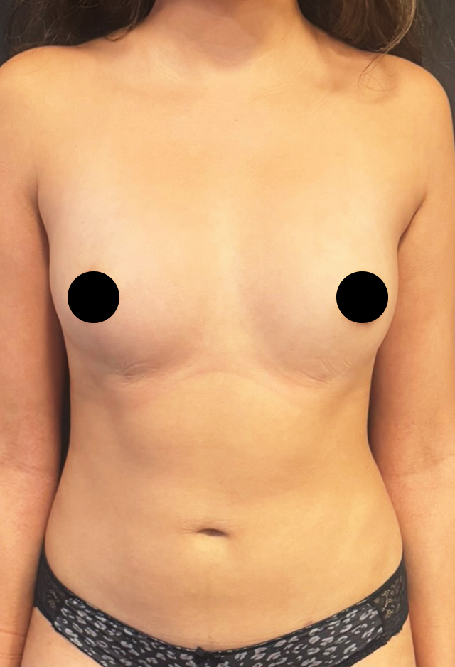 Fat transfer after