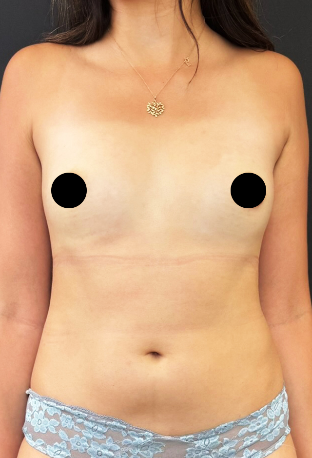 Fat transfer before