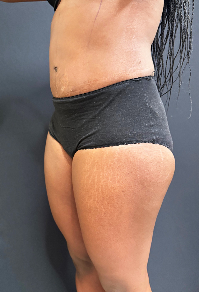 Tummy tuck after