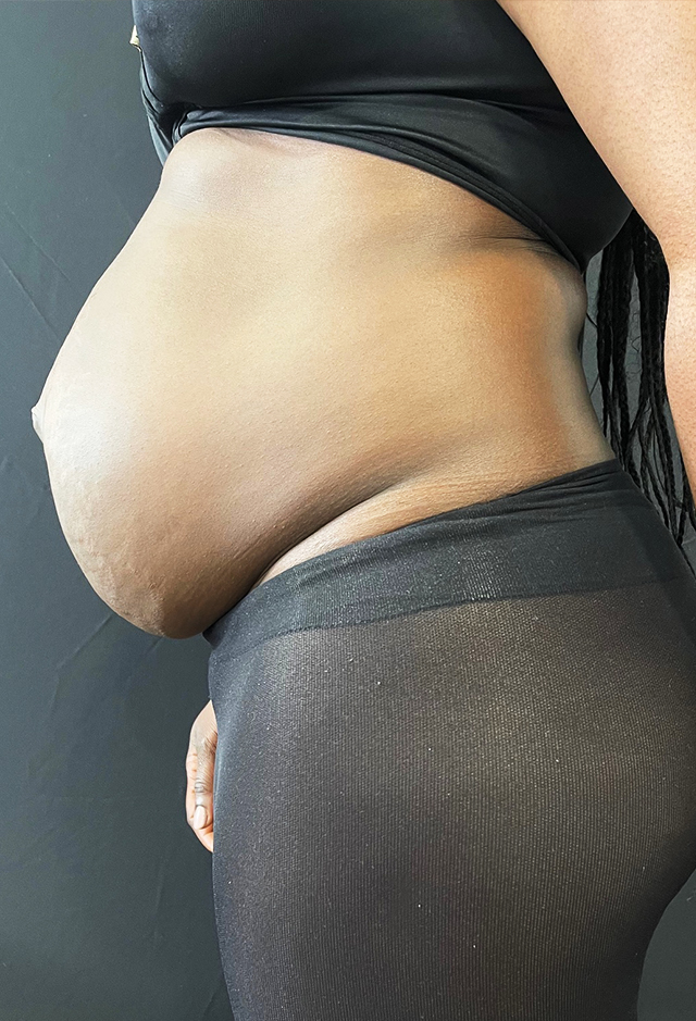 Tummy tuck before