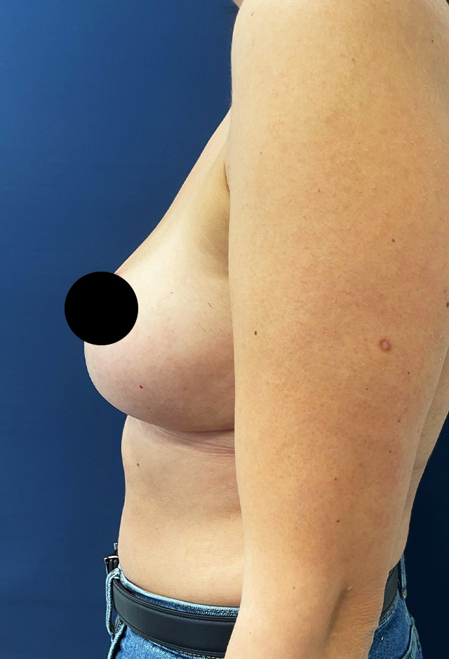 Breast implant removal after