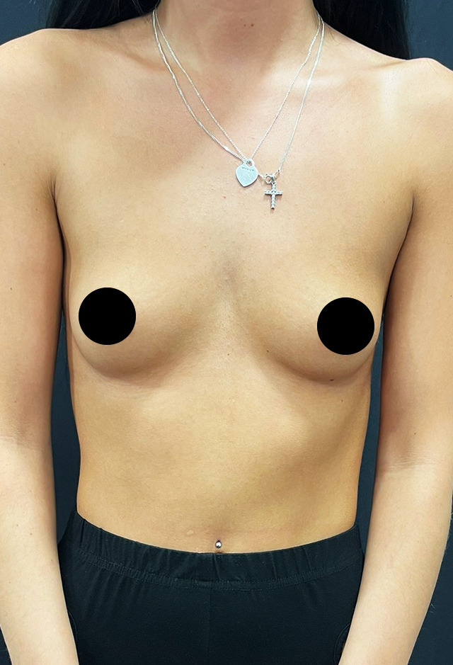 Breast augmentation before
