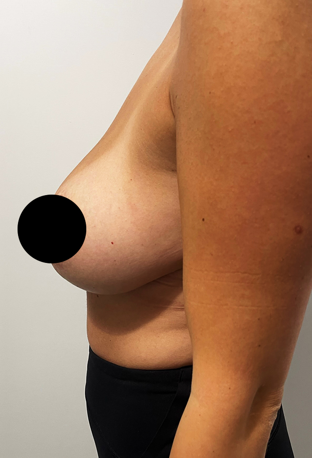 Breast implant removal before