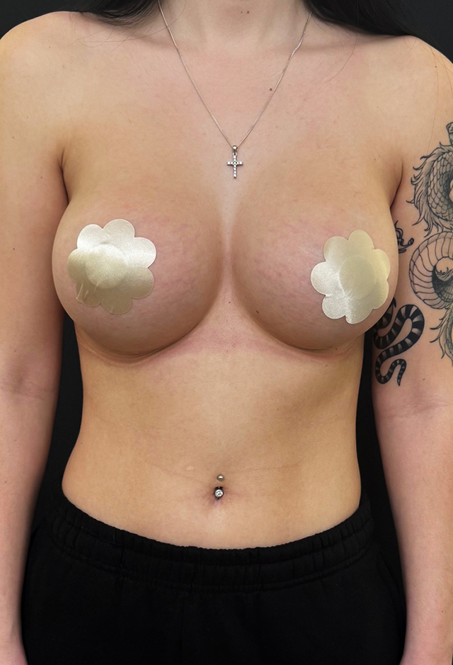 Breast augmentation after