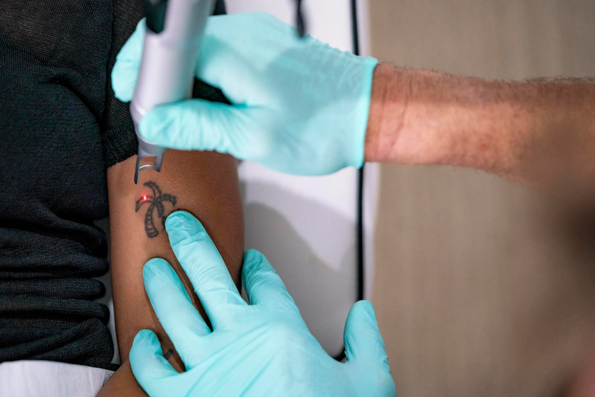 Close-up of a person’s arm with a palm tree tattoo being targeted with a laser device by a technician wearing blue gloves.