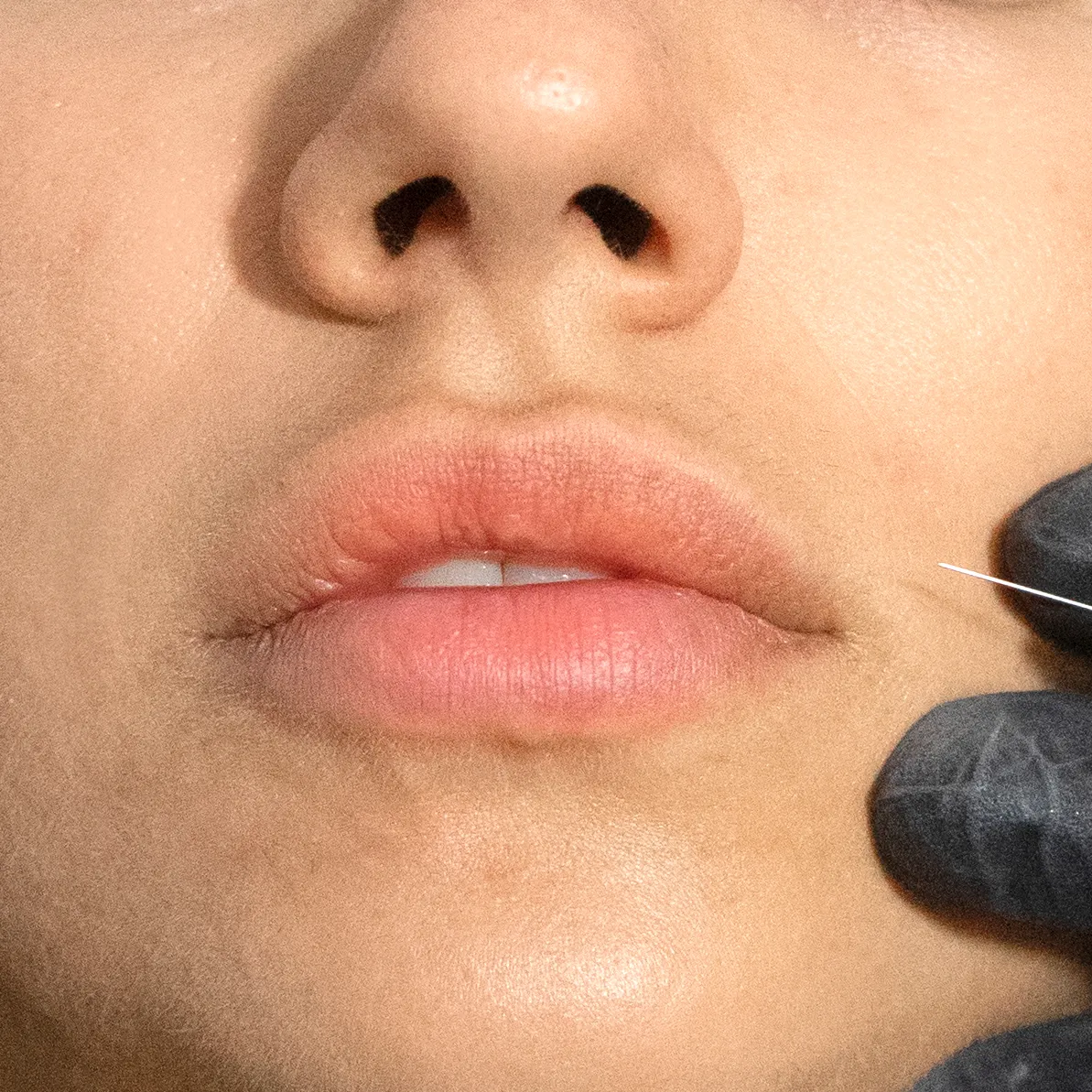 Close-up of a person's lips and nose with a gloved hand holding a needle near the lip, suggesting a cosmetic injection.