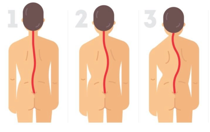 Stopnie skoliozy u dzieci — kąt Cobba: łagodna 10-25 stopni, umiarkowana 25-40 stopni, ciężka powyżej 40 stopni