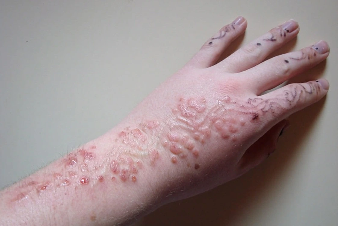 Eliminación de tatuaje por razones médicas en Alef Med Valencia
