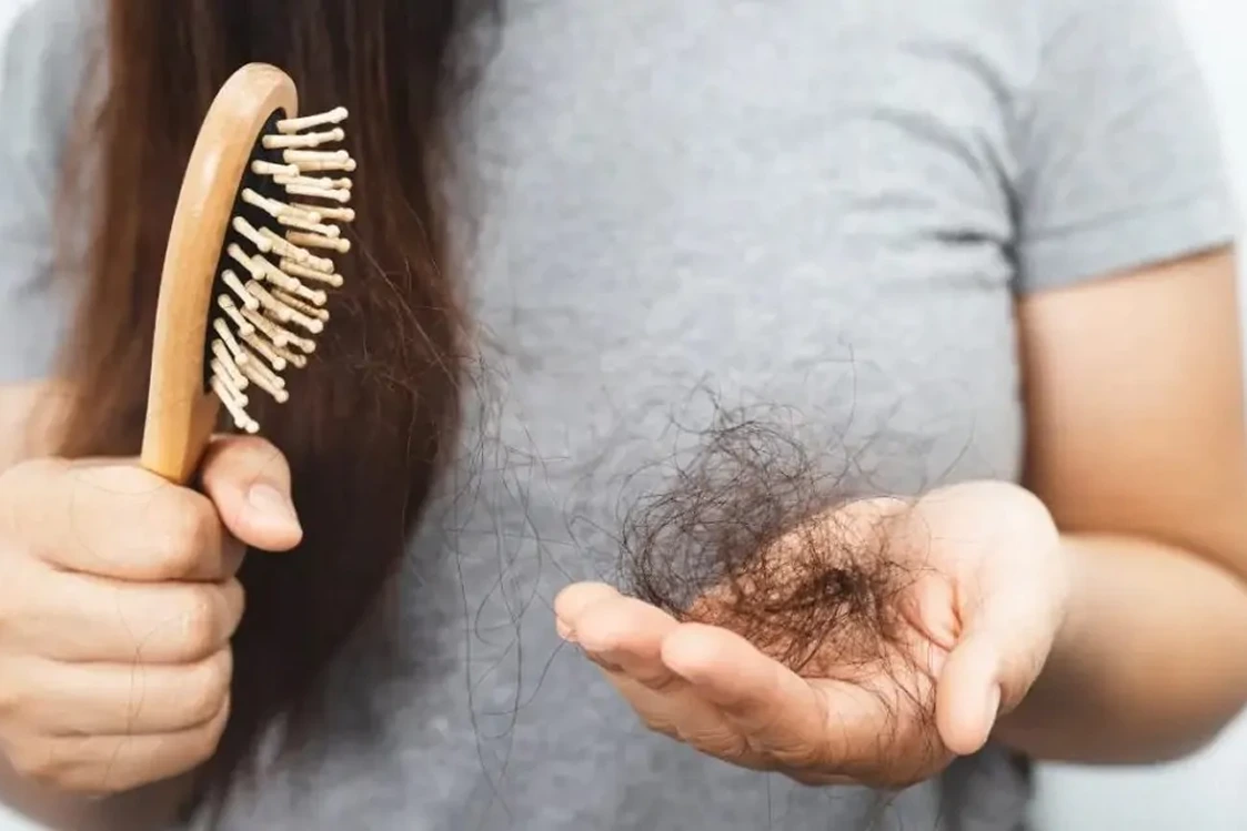 Caída excesiva del cabello evaluada en diagnóstico capilar en Alef Med Valencia