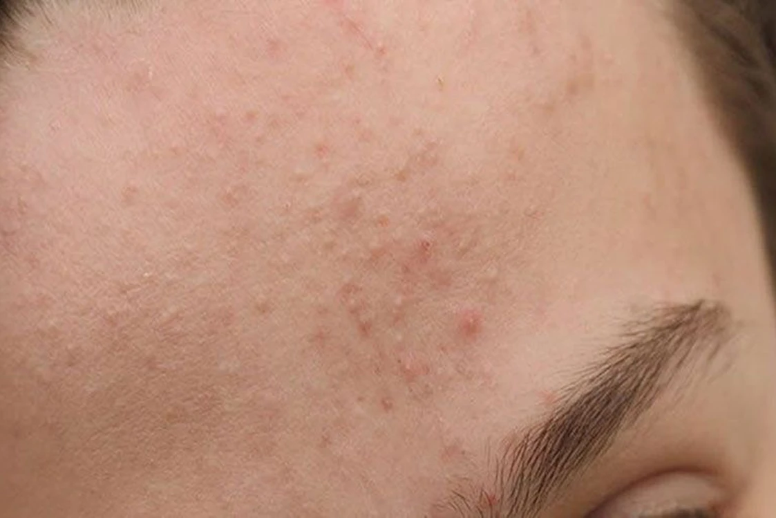 Comedones tratados con limpieza facial combinada en Alef Med Valencia