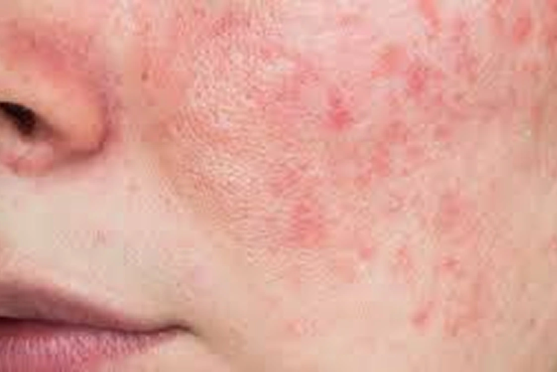 Sensibilidad y enrojecimiento evaluados en diagnóstico facial en Alef Med Valencia