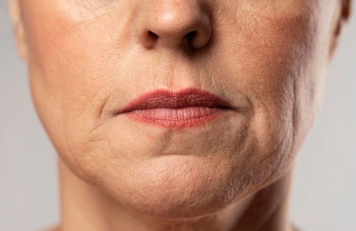 Arrugas y pérdida de firmeza tratadas con Microneedling en Alef Med Valencia