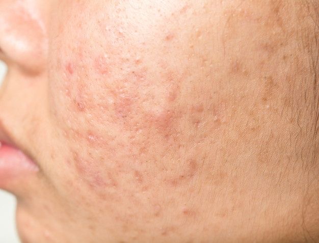 Acné y postacné tratados con peeling Derma Glow en Alef Med Valencia
