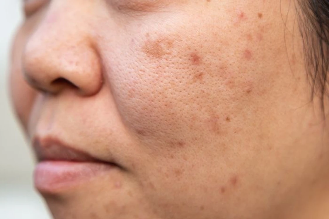 Pigmentación y cicatrices tratadas con peeling en Alef Med Valencia