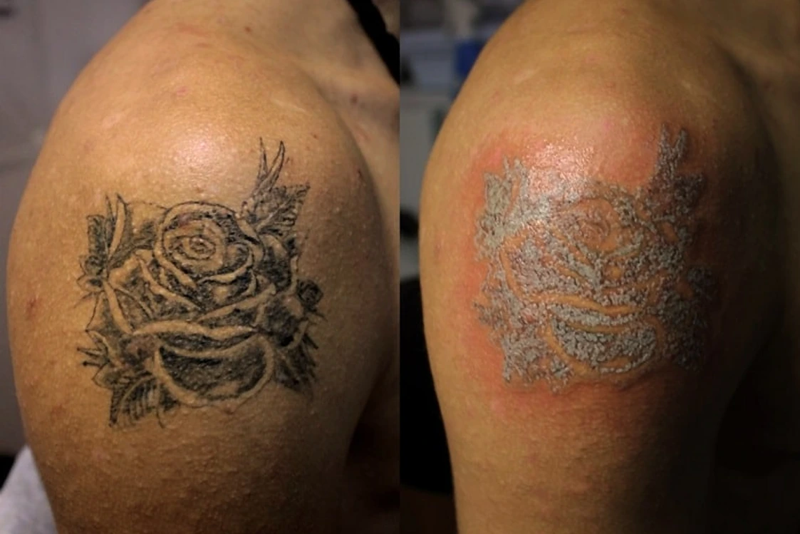 Tatuaje decolorado con el tiempo antes de eliminación en Alef Med Valencia