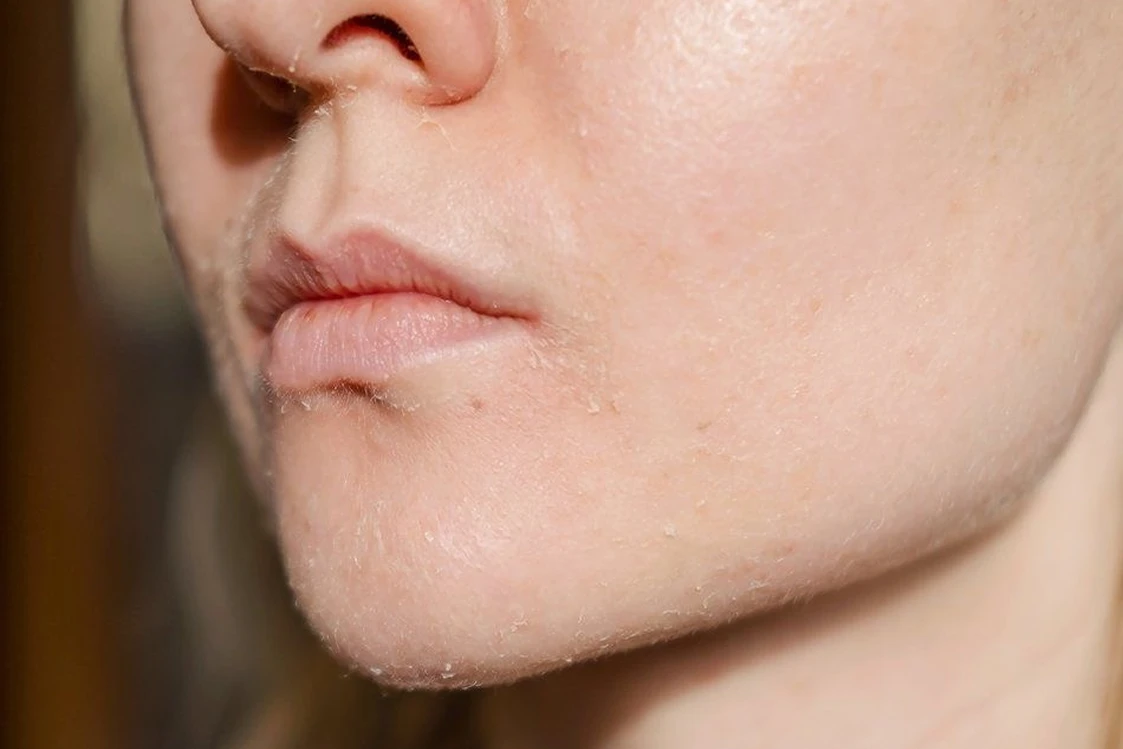Piel deshidratada tratada con Hydropeeling en Alef Med Valencia