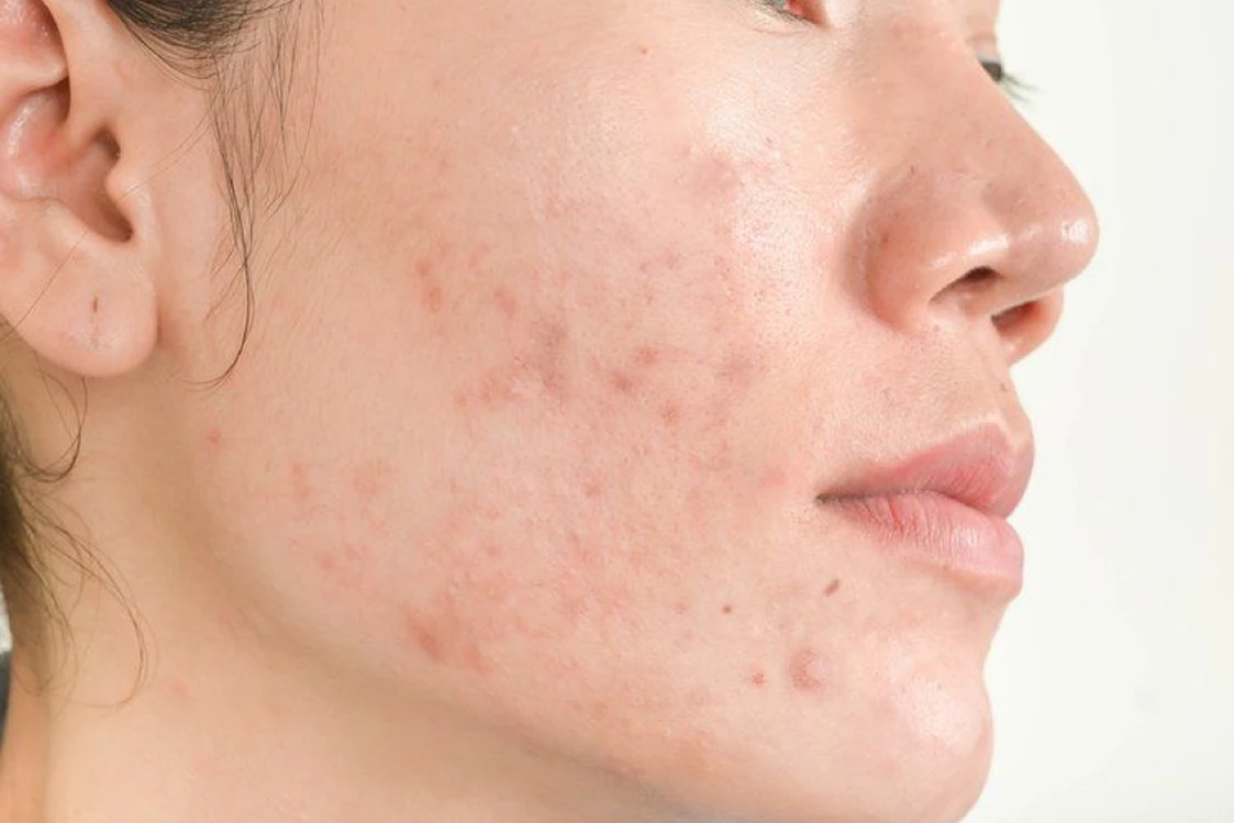 Manchas post-acné tratadas con Microneedling en Alef Med Valencia