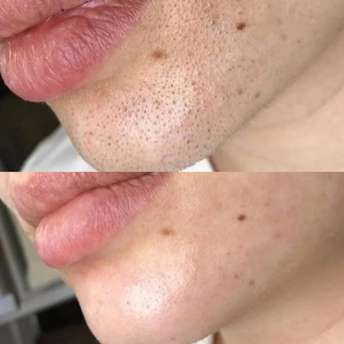 Resultado antes y después de limpieza facial combinada, caso 2, en Alef Med Valencia