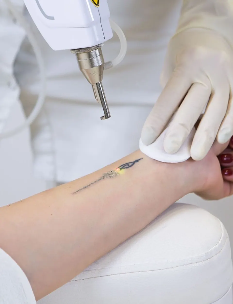 Laser tattoo removal at Alef Med clinic in Valencia