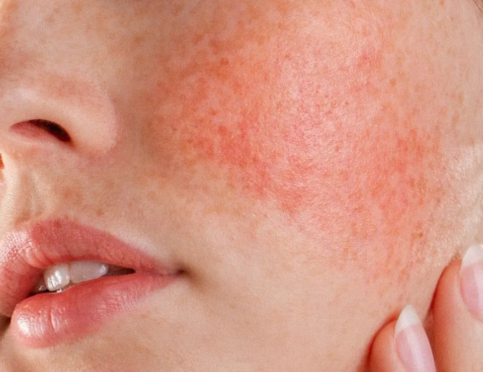 Pigmentación y rosácea tratadas con Derma Glow en Alef Med Valencia