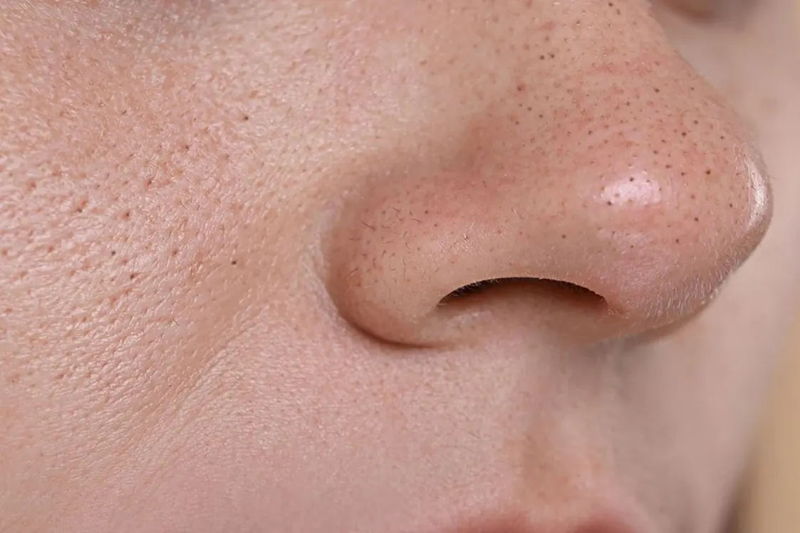 Puntos negros tratados con limpieza facial combinada en Alef Med Valencia